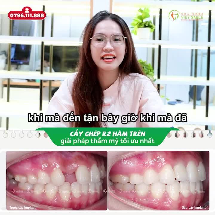 TRỒNG IMPLANT KHẮC PHỤC RĂNG THIẾU DO BẨM SINH