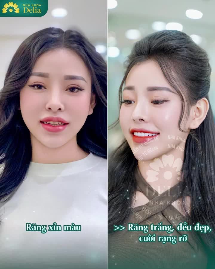 TOP 5 CA BỌC RĂNG SỨ VISUAL "XUẤT SẮC" TẠI DELIA HÀ NỘI