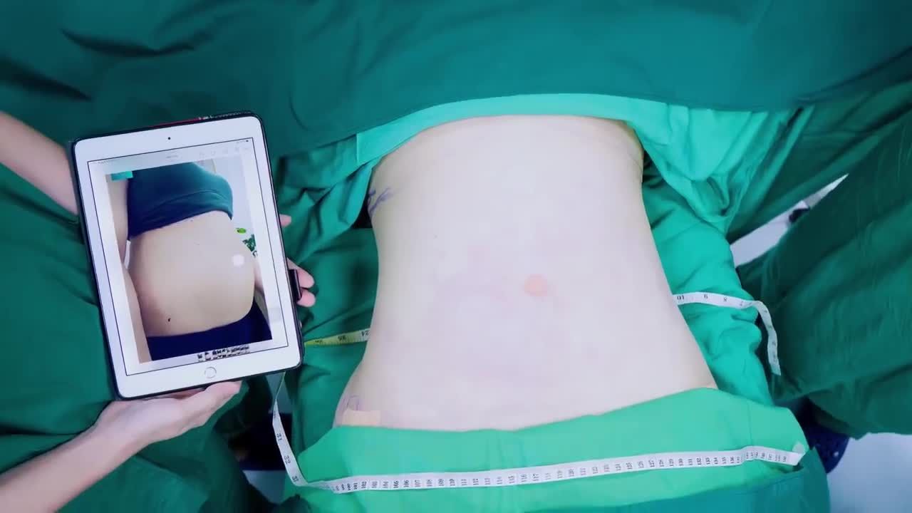 Ngay lúc này, ekip Bác sĩ Lương Ngọc vừa hoàn tất quá trình hút mỡ bụng siết eo cho bạn khách trẻ đến từ Đài Loan