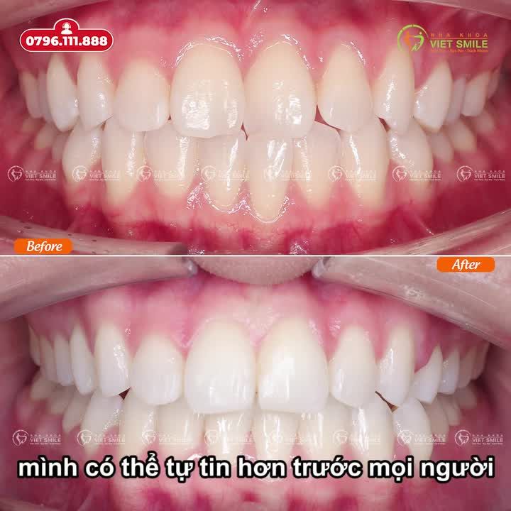 CHIA SẺ DỄ THƯƠNG VÀ CHÂN THẬT CỦA KHÁCH HÀNG SAU THÁO NIỀNG