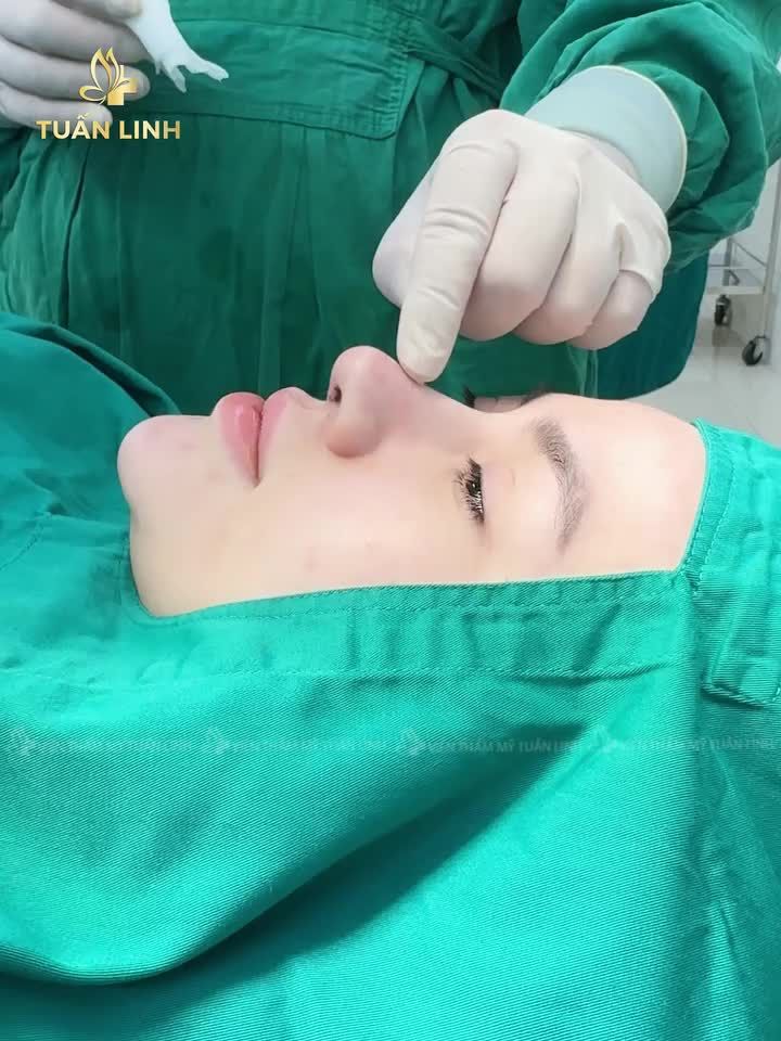 Mũi nâng cấp đẹp XUẤT SẮC sau 90 phút!!