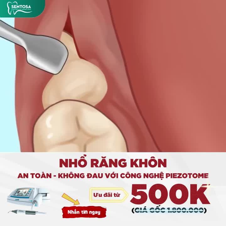 NHỔ RĂNG KHÔN AN TOÀN - KHÔNG ĐAU VỚI CÔNG NGHỆ PIEZOTOME