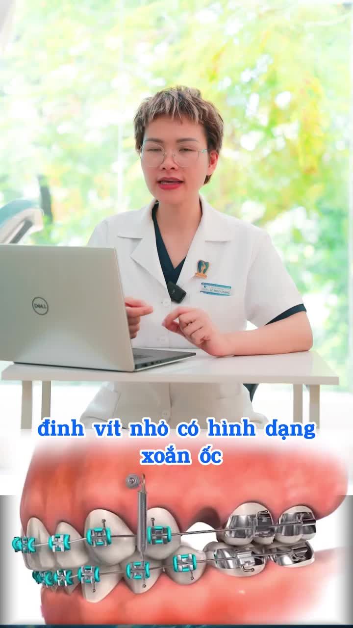 Khi nào cắm minivis trong chỉnh nha