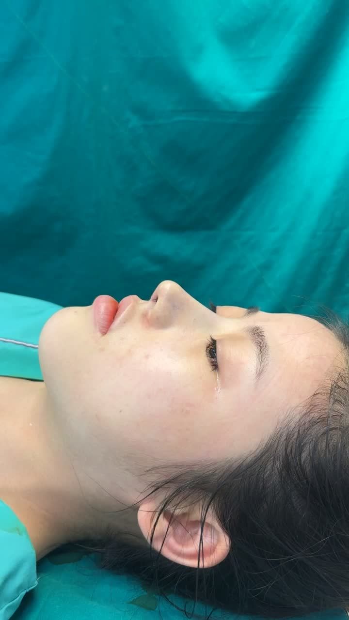 Case mũi cấu trúc vừa hoàn thành