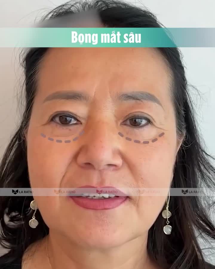 CĂNG DA MẶT SMAS FACE - GIỮ NGUYÊN DÁI TAI PHÚC TƯỚNG