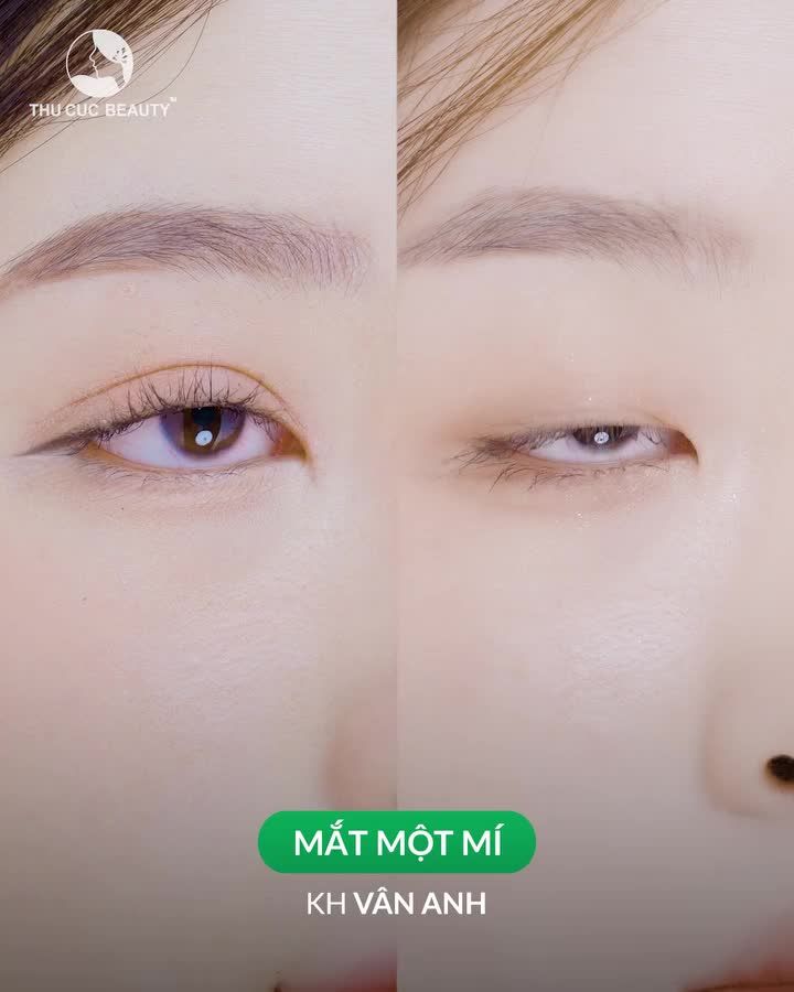 Những nếp mí nào thì nên đi can thiệp thẩm mỹ?
