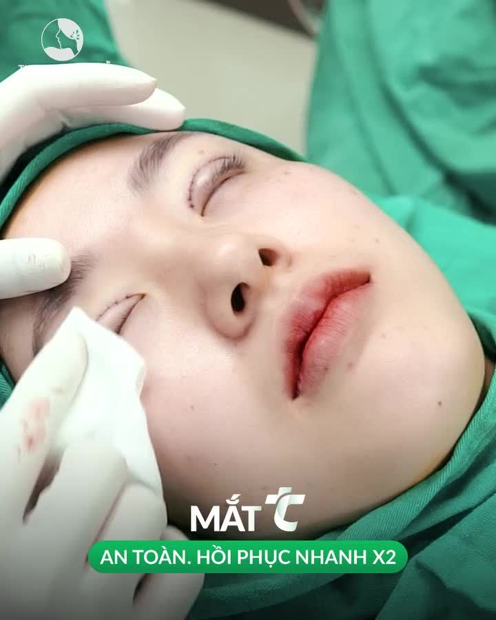 3 ngày có ngay nếp mí đẹp cùng ưu đãi tháng Ngâu Chi phí cắt mí không thể hời hơn