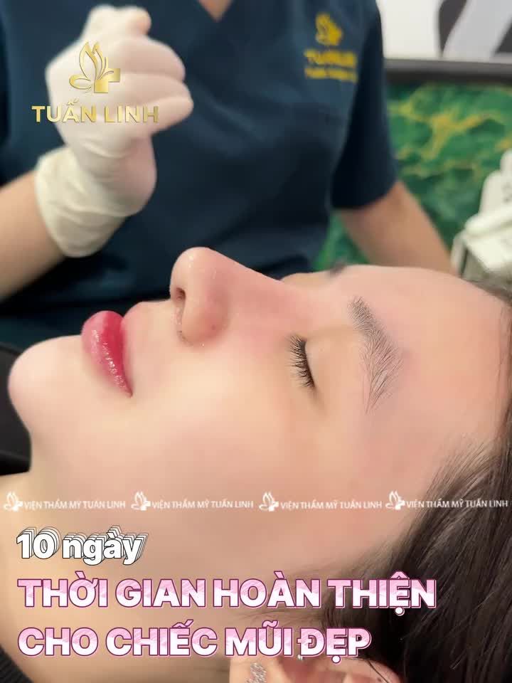 10 ngày - Thời gian gom form cho chiếc mũi chuẩn đẹp tại Tuấn Linh!!