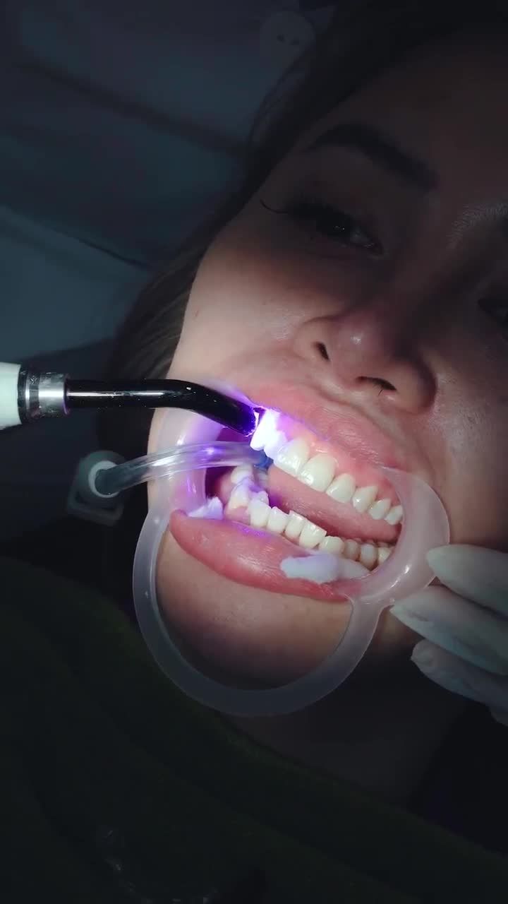 QUÁ TRÌNH NIỀNG RĂNG TRONG SUỐT INVISALIGN CHO MỘT NỮ KHÁCH HÀNG