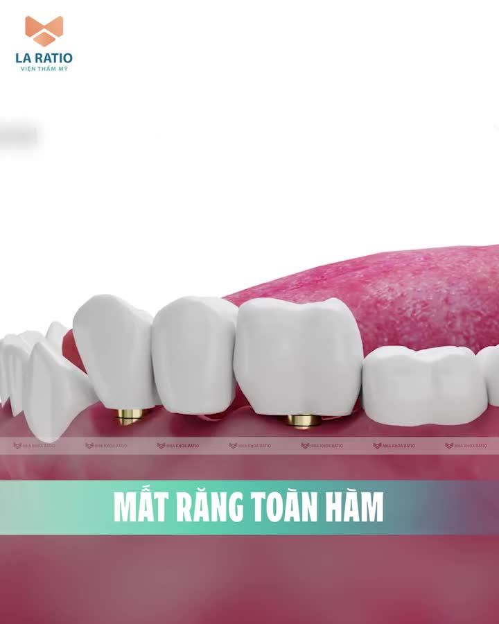 QUY TRÌNH CẤY GHÉP IMPLANT "2 THÌ" MẤT BAO LÂU?