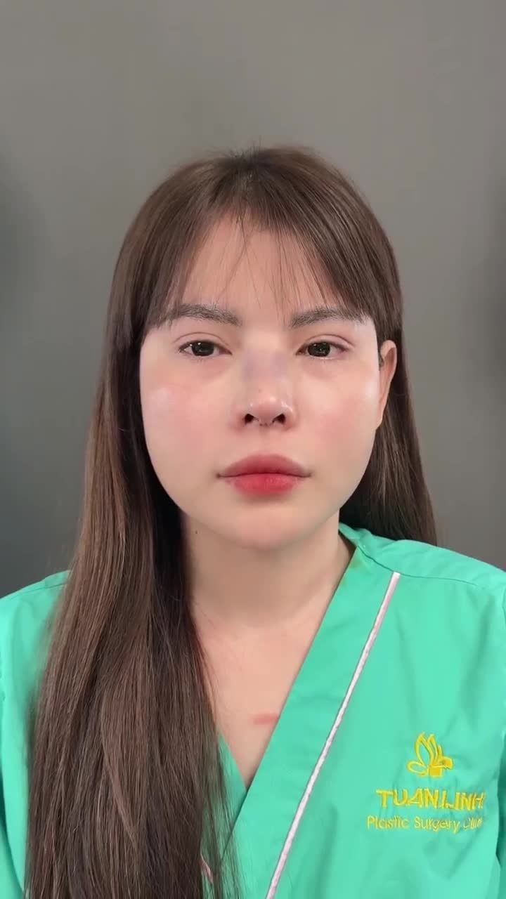 Case mũi cấu trúc đẹp xuất sắc sau 90 phút cho chị gái đến từ Đà Lạt!!