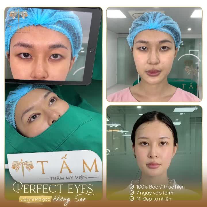 Ca mắt vừa hoàn thành vô cùng trộm vía của bạn khách hàng sử dụng dịch vụ Perfect Eyes : Cắt mí - Mở góc trong.