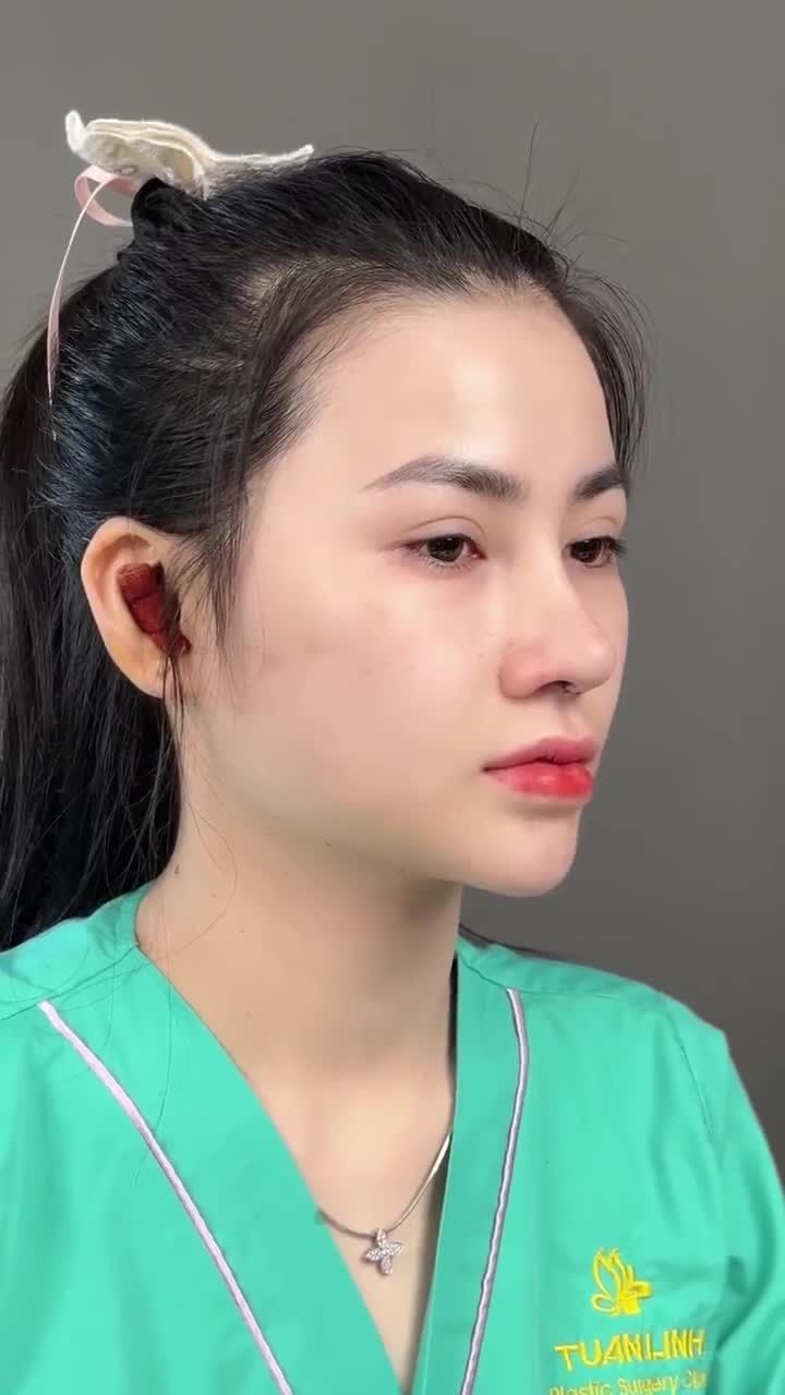 Kết quả nâng mũi cấu trúc sửa lại sau 90 phút