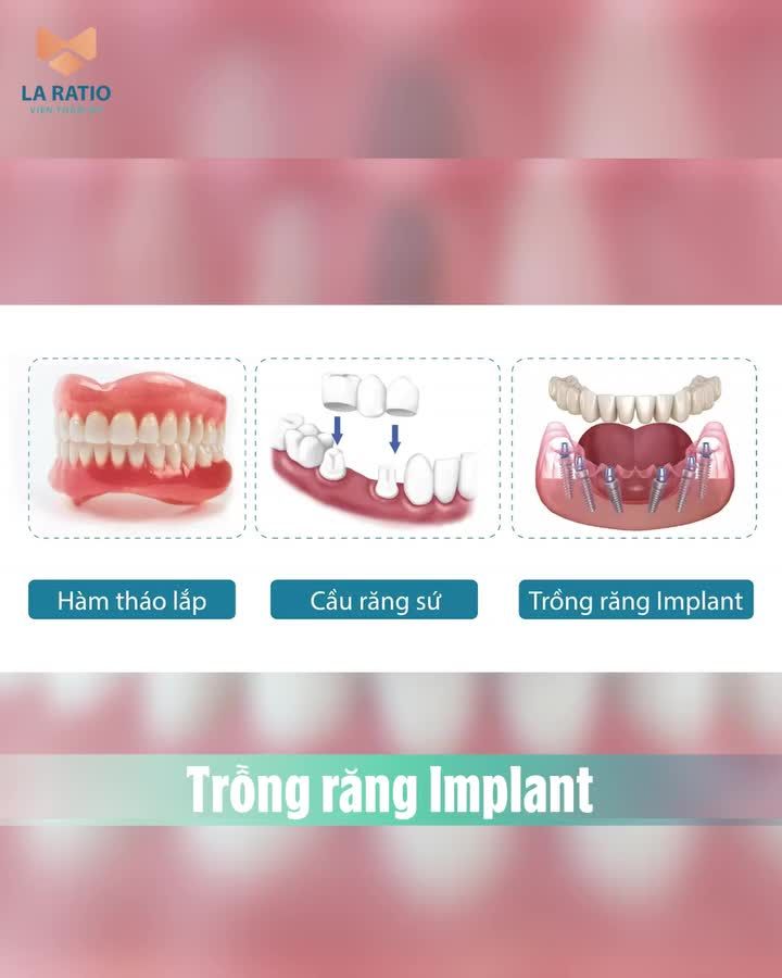Trồng răng Implant có tốt hơn các phương pháp khác?