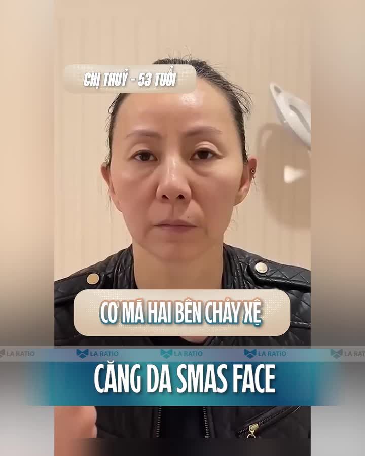 Căng da mặt Smas Face -  Phương pháp trẻ hóa đánh bại sự tàn phá của thời gian