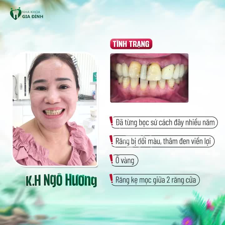 KHI RĂNG SỨ CŨ BỊ HỎNG ĐÃ ĐẾN LÚC THÁO RA ĐỂ PHỤC HÌNH LẠI, CẢI THIỆN TÍNH THẨM Ỹ CỦA NỤ CƯỜI