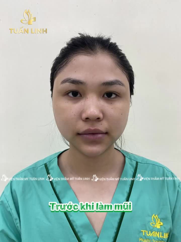 Hành trình 10 ngày Thay dáng mũi - Đổi gương mặt của cô nàng GenZ nhà Tuấn Linh!!