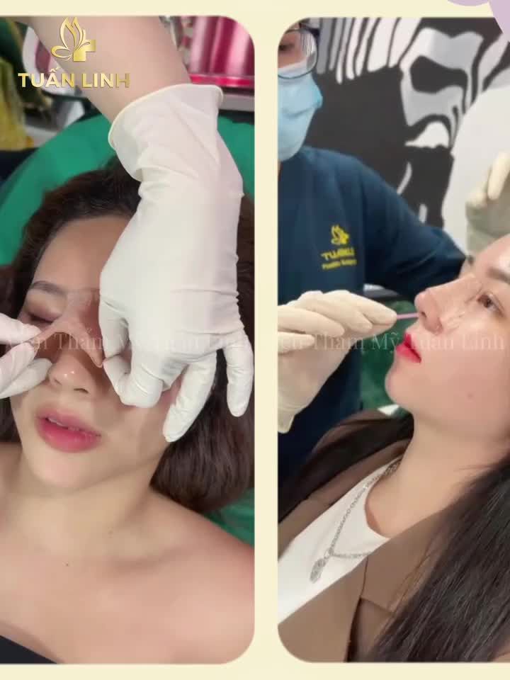 NÂNG MŨI BỌC SỤN TỰ THÂN CÒN 16999TR TRỌN GÓI!!