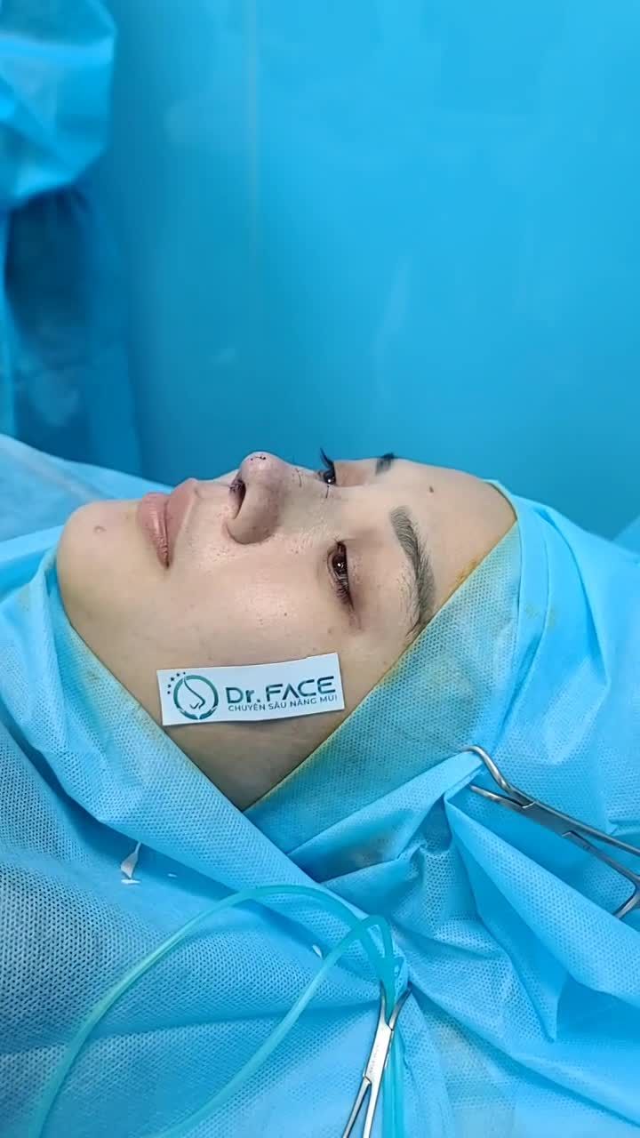 Mũi Này Cấy Chỉ 3 Năm, Nay Bs Rút Chỉ Và Nâng Mũi Cấu Trúc