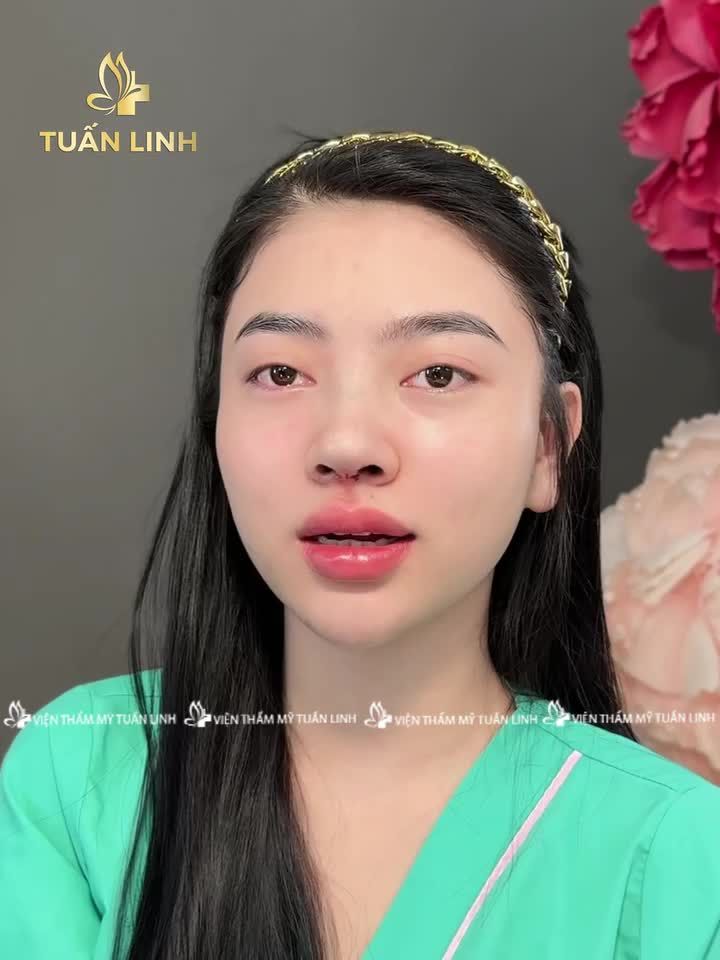 Chia sẻ trực tiếp của khách hàng sau 90 phút thực hiện nâng mũi cấu trúc tại Tuấn Linh!!!