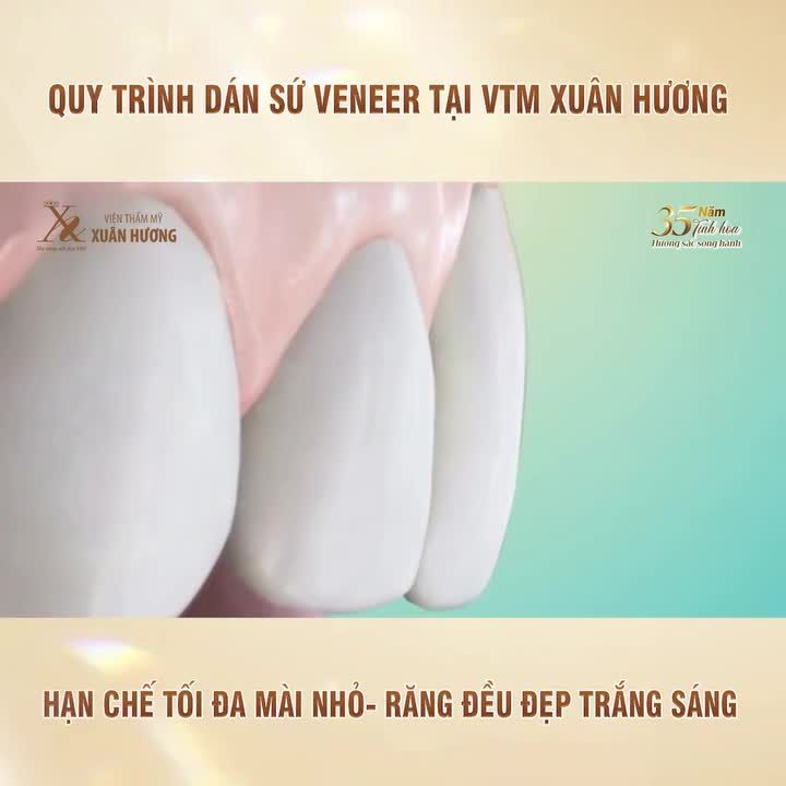 Phương pháp thẩm mỹ răng sứ được yêu thích nhất tại Xuân Hương