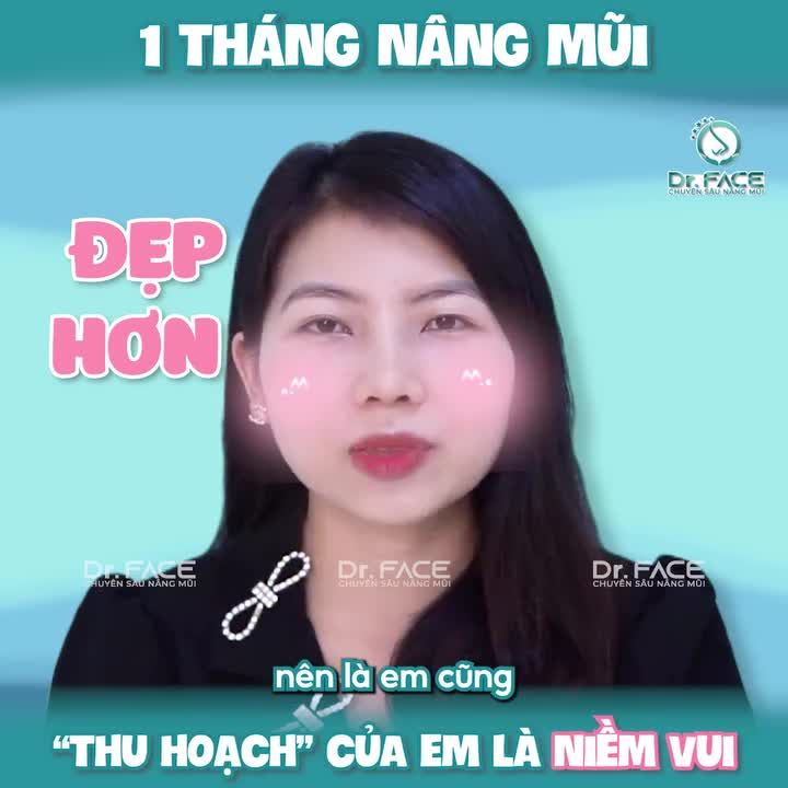 1 THÁNG nâng mũi “THU HOẠCH” của em là NIỀM VUI