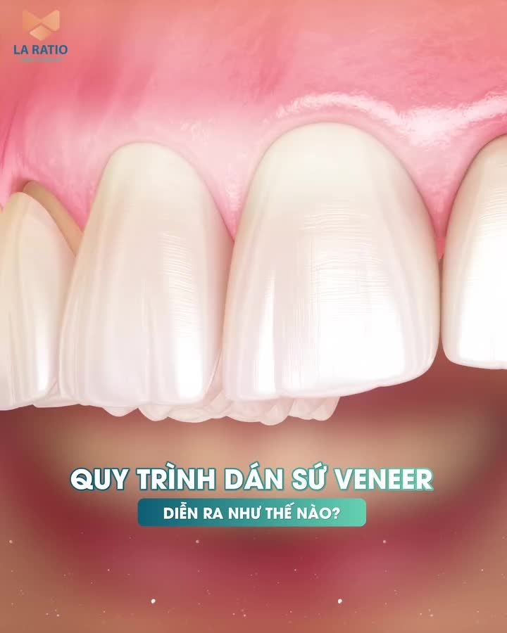 Quy trình dán sứ Veneer tại Nha khoa Ratio diễn ra như thế nào?