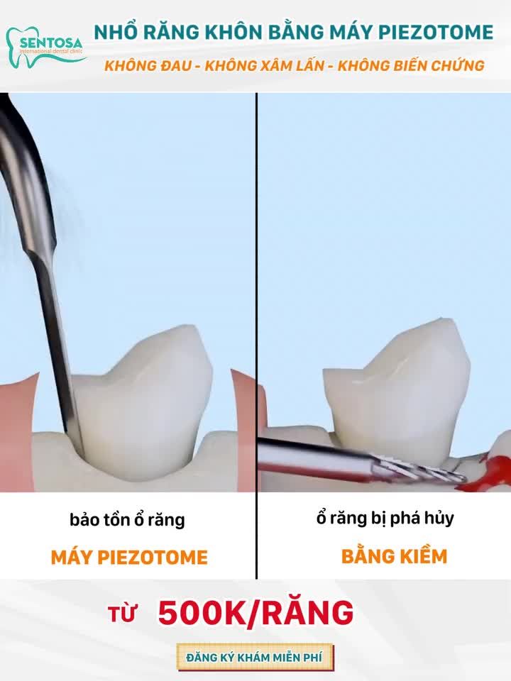 NHỔ RĂNG KHÔN BẰNG MÁY PIEZOTOME KHÔNG ĐAU, XÂM LẤN, BIẾN CHỨNG