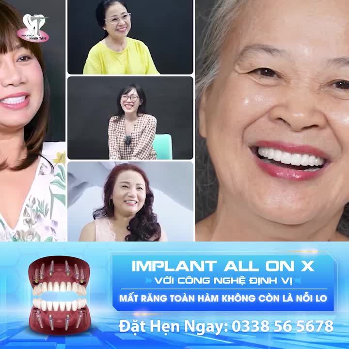 Ăn nhai khỏe mạnh - Tự tin giao tiếp với trồng răng Implant