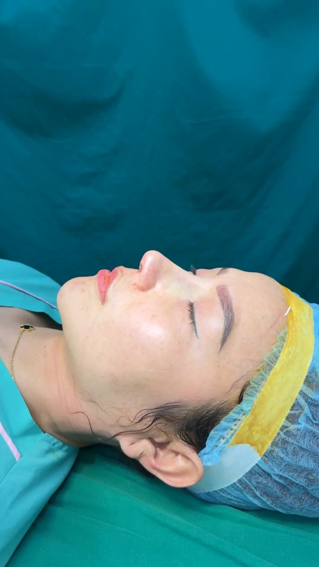 Case mũi Siêu cấu trúc sụn surgiform vừa hoàn thành cho bạn khách hàng từ nước ngoài về!!