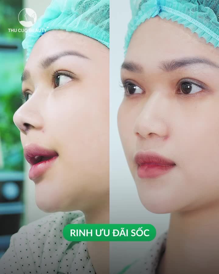 Đây chính là thời điểm "vàng" để bạn nâng mũi với giá siêu hời