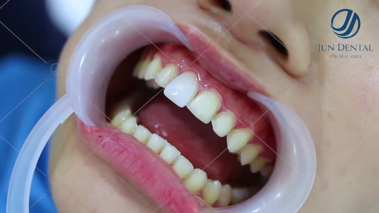 Cận cảnh dán sứ tại Jun Dental. Bảo tồn tối đa răng gốc, giúp bạn có hàm răng trắng đẹp và chắc khoẻ theo thời gian