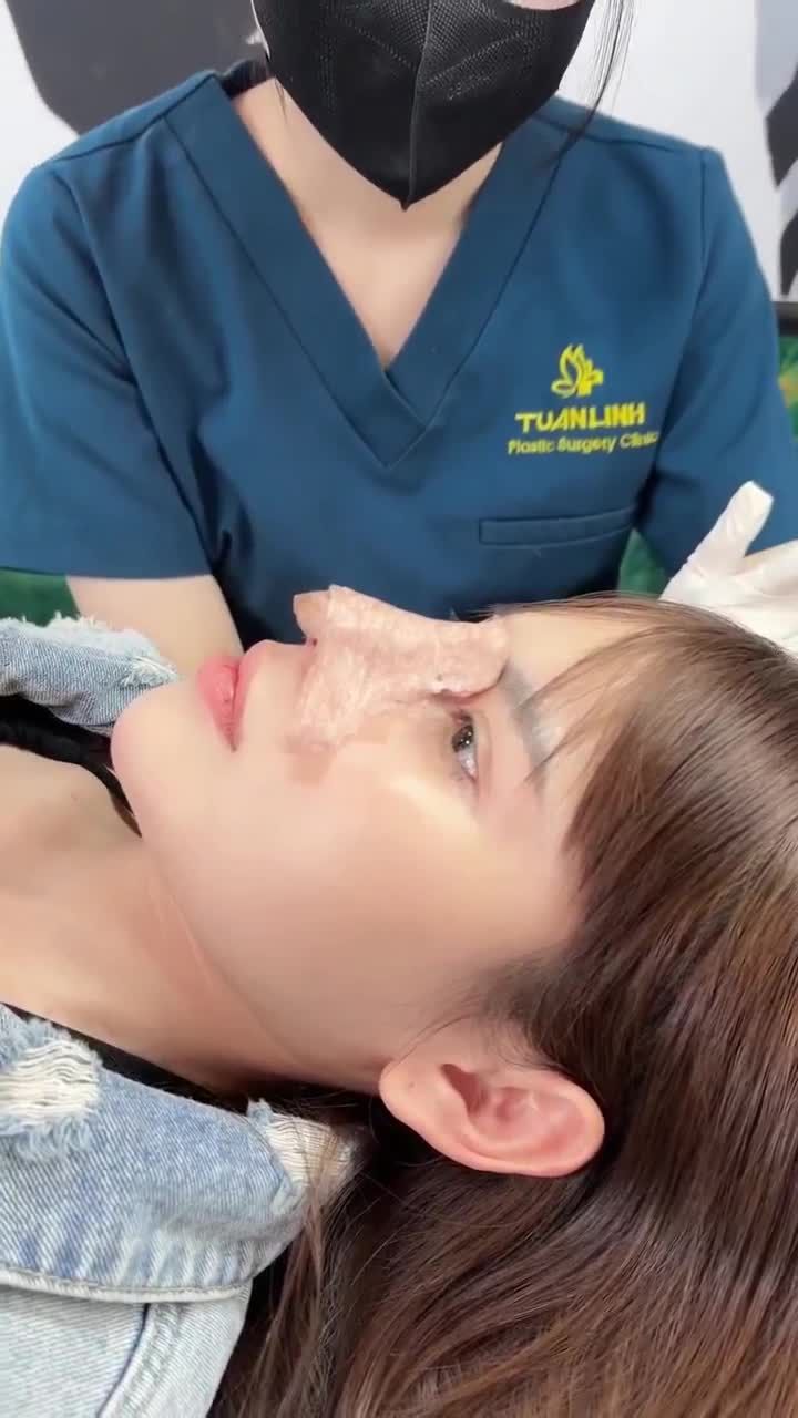 Tháo nẹp mũi cấu trúc sau 10 ngày