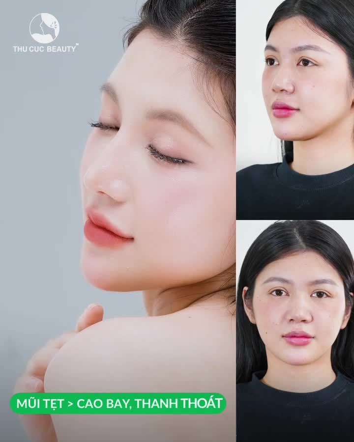 KH Thùy Vy đã lựa chọn Mũi TC để xóa sổ sống mũi thấp