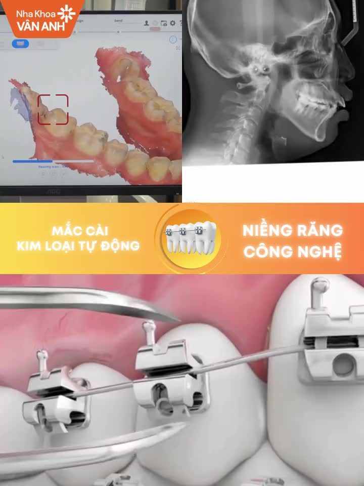 NIỀNG RĂNG MẮC CÀI TỰ ĐỘNG - RÚT NGẮN ĐIỀU TRỊ 6 THÁNG