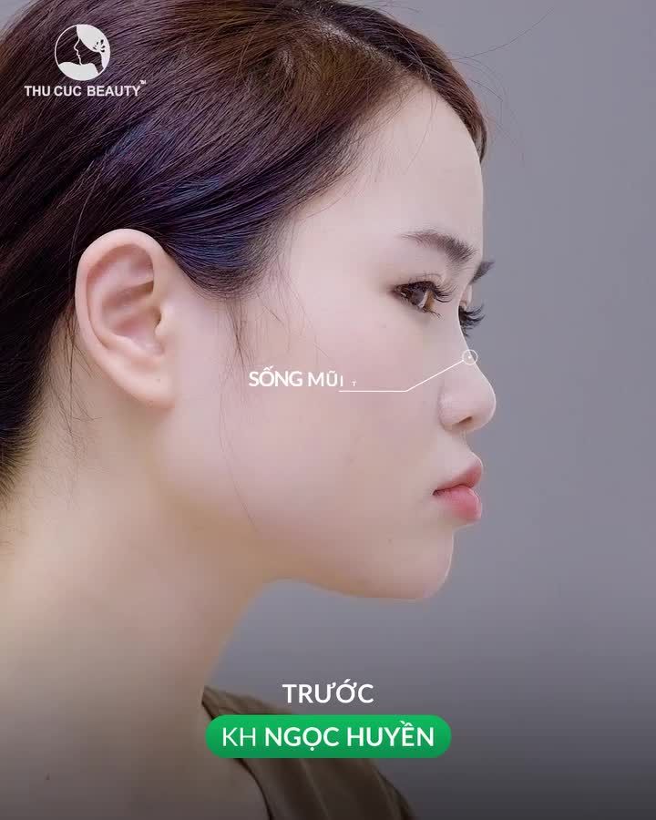 Mũi TC - Dáng mũi tự nhiên. Bền đẹp theo thời gian