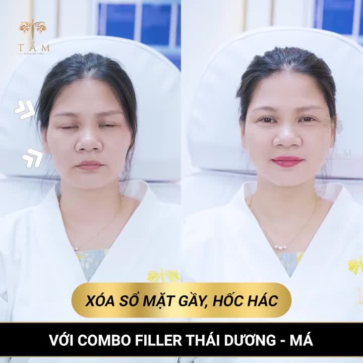 Không đau - Không sưng - Không phẫu thuật. Trẻ hóa vùng Má - Thái Dương với Filler tại Tấm!