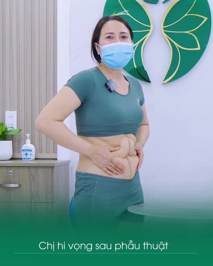 Nỗi ám ảnh "bụng hỏng" của chị khách hàng đã từng trải qua phẫu thuật tạo hình thành bụng 3 năm trước!