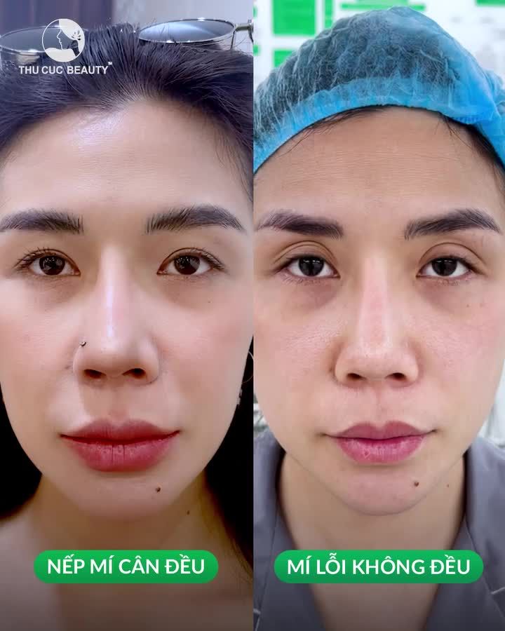 Sinh hoạt bình thường ngay sau khi phẫu thuật xong
