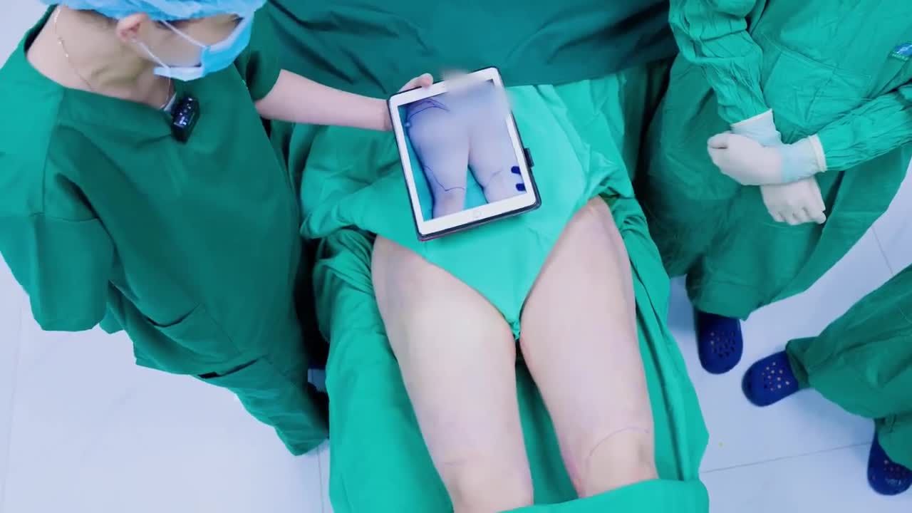 Chị Thảo quyết định trở lại và tiếp tục thực hiện hút mỡ tạo dáng vùng đùi để body thêm hài hòa, cân đối, hoàn hảo hơn.