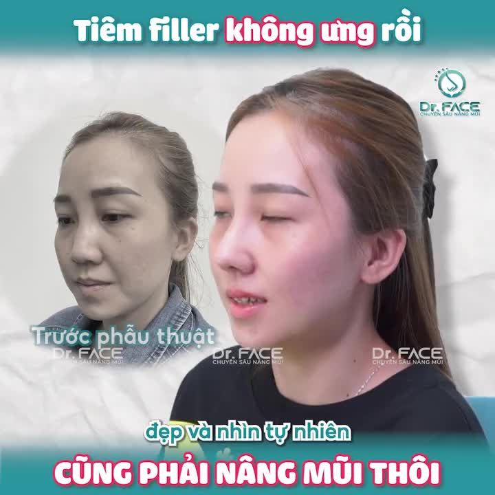 TIÊM FILLER không ưng RỒI CŨNG PHẢI NÂNG MŨI thôi!