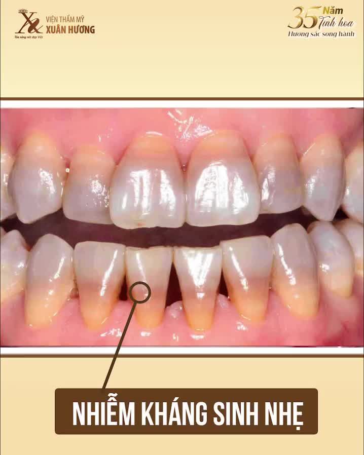 RĂNG TRẮNG CƯỜI XINH - TỎA SÁNG ĐÓN LỄ
