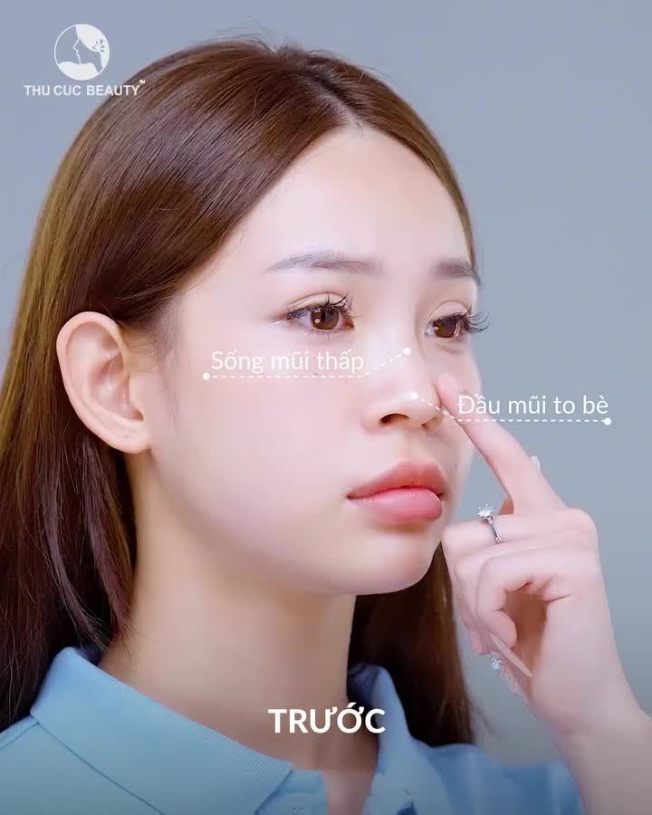 KH Minh Hạnh đã lựa chọn Mũi TC để xóa sổ sống mũi thấp