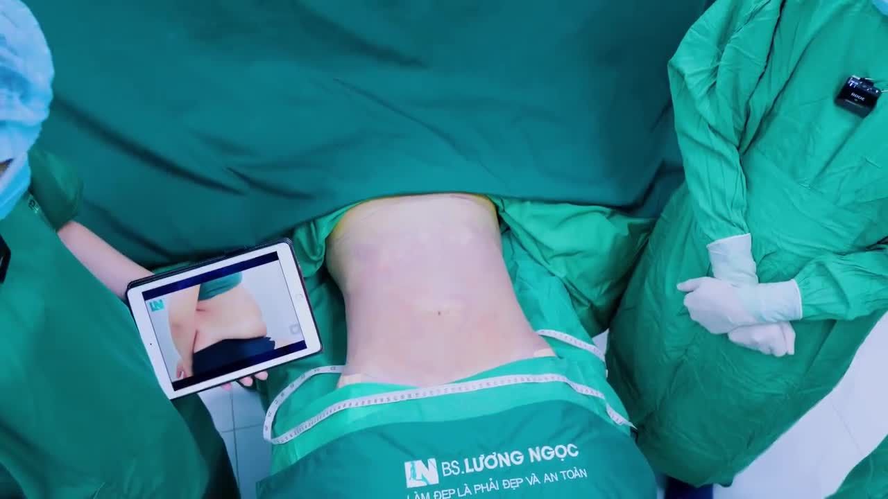 Không cần phẫu thuật, không đau đớn, chỉ sau 1 giờ thực hiện hút mỡ bụng siết eo ekip Bác sĩ Lương Ngọc, chị Linh đã có được vòng eo thon gọn thắt đáy mơ ước.