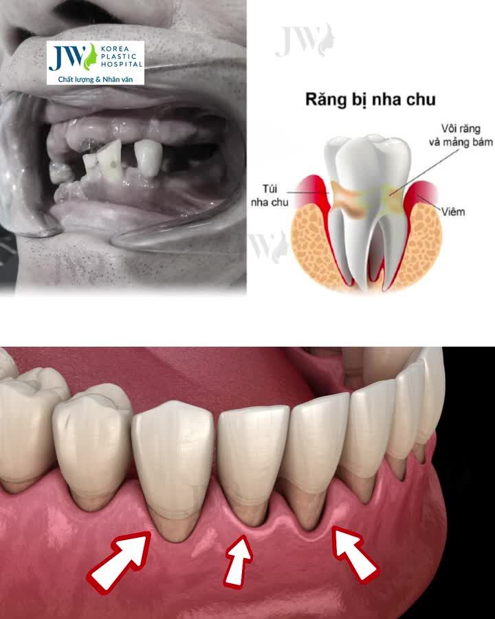 CĂNG NHƯ DÂY ĐÀN: Quý ông Việt kiều Mỹ U60 RỤNG RĂNG TOÀN HÀM bay về JW cầu cứu