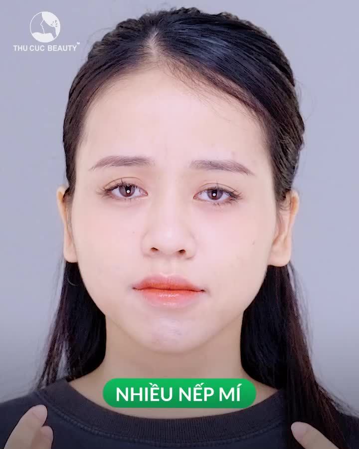 Cắt mí TC Chỉ khâu và đường khâu thẩm mỹ. Sẹo tàng hình