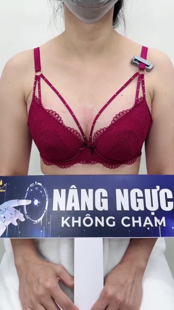 10 ngày NÂNG NGỰC KHÔNG CHẠM NANO MOTIVA SIZE 300CC - 285CC