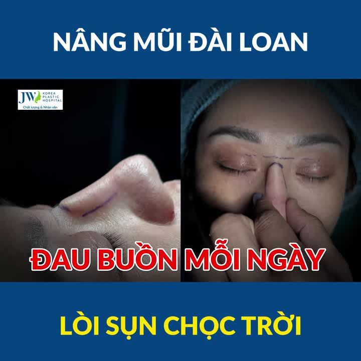 TÁ HOẢ Bác sĩ Tú Dung cứu Chị gái Việt kiều Nâng mũi Đài Loan LÒI SỤN CHỌC THẲNG TRỜI