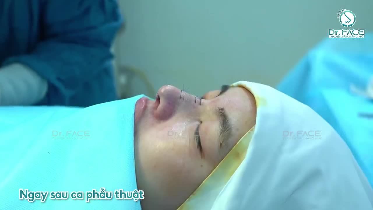 DA MŨI MỎNG QUÁ thì ĐỘ CAO như này là vừa đủ