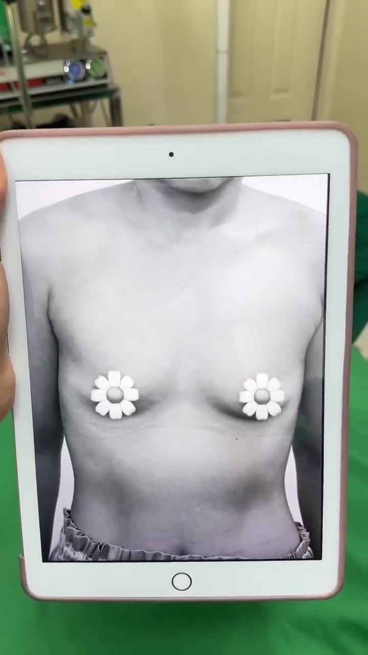 NÂNG NGỰC KHÔNG CHẠM